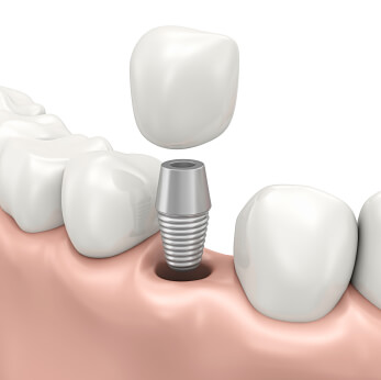 Implant Dentaire Montréal