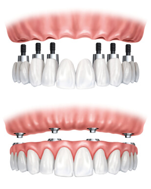 Implant Dentaire avec Prothese Fixe Montréal