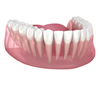 Dentiste Montreal - Soins Parodontaux